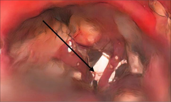 Dandy's vein decompression for trigeminal neuralgia: A rare venous conflict causing intractable facial pain.