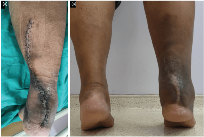Experience in Managing a Complex Case of Infected Achilles Tendon Rupture with Segmental Loss: A Case Report.