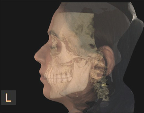 Comparative evaluation of the accuracy of three different three-dimensional facial scanning systems: An observational crossover study.