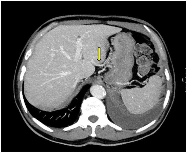 CT imaging of third inflow cases: a hidden cause of surgical complications and liver pseudolesions.