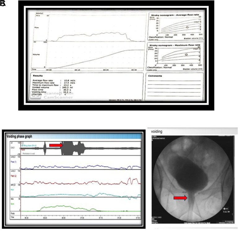 Diagnosing Dysfunctional Voiding Non-Invasively: The SHADE Criteria Approach.