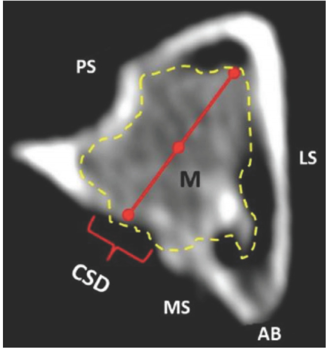 Radiographical Assessment of Injectable Calcium Phosphate Bone Cement (Osteopaste) in Critical Size Bone Defects of Rabbit's Tibia Model.