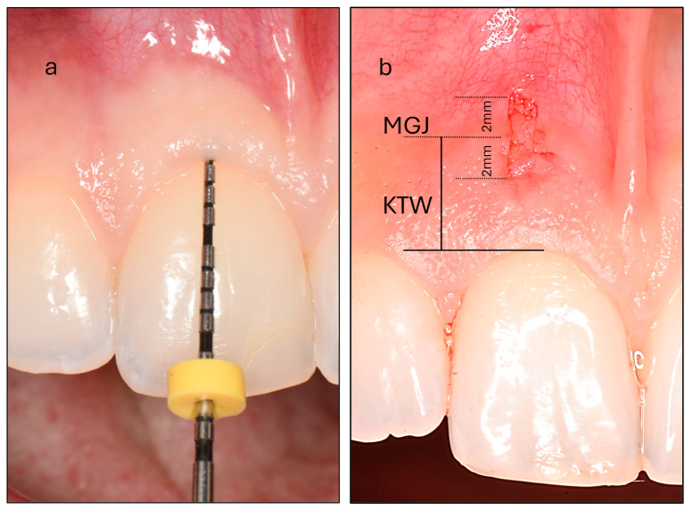 Histomorphometric Evaluation of Gingival Phenotypic Characteristics: A Cross-Sectional Study.