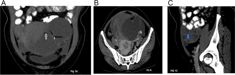 Rare co-occurrence of appendicitis, ovarian dermoid cyst with torsion: a case report.