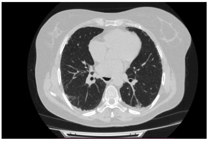 Reclassification of Seronegative Rheumatoid Arthritis as Anti-PL-12 Antisynthetase Syndrome with Interstitial Lung Disease and Joint Involvement-Case Report.
