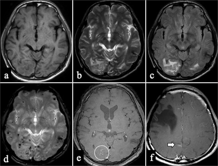 Probable cerebral amyloid angiopathy-related inflammation presenting with dissociated hemorrhagic and inflammatory lesions in a middle-aged patient: A case report.