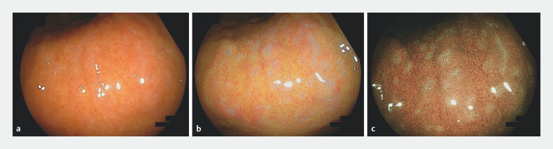 Barnacle-like lesions in the gastric mucosa: Clinicopathological study of a novel endoscopic finding.