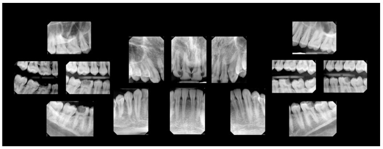 A Mixed-Methods Case Report on Oral Health Changes and Patient Perceptions and Experiences Following Treatment at the One Smile Research Program: A 2-Year Follow-Up.