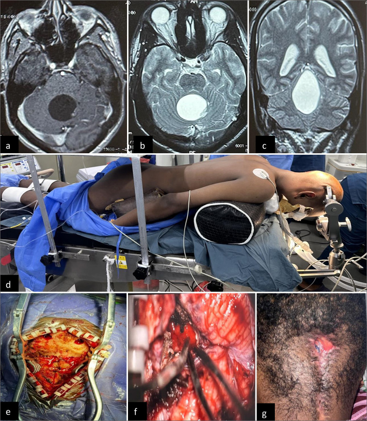 Complications of brain tumor surgery.