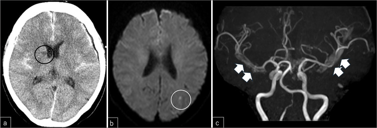 Appearance of an anterior communicating artery aneurysm during vasospasm treatment after angiogram-negative subarachnoid hemorrhage: A case report.