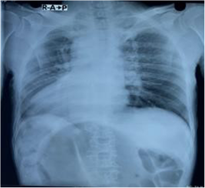 A case of situs inversus totalis with sigmoid volvulus: a case report of a rare coexistence.