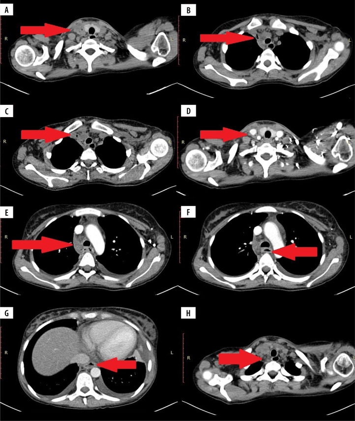 Rare complications of Crohn's disease - a series of three cases.