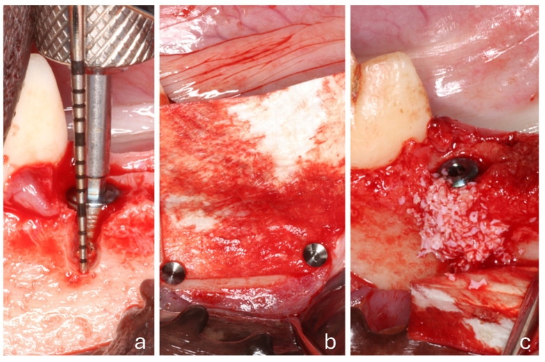 The Effect of Collagen Membrane Fixation with Pins on Buccal Bone Regeneration in Immediate Dental Implant Sites: A Preclinical Study in Dogs.