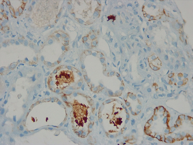 Hypothyroidism Related Kidney Disease - A Report of Two Cases.
