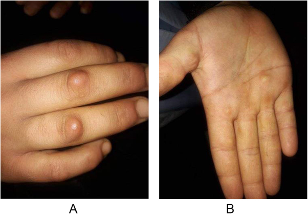A rare presentation of subcutaneous granuloma annulare: a case report of bilateral palmar and dorsal hand nodules with successful management.