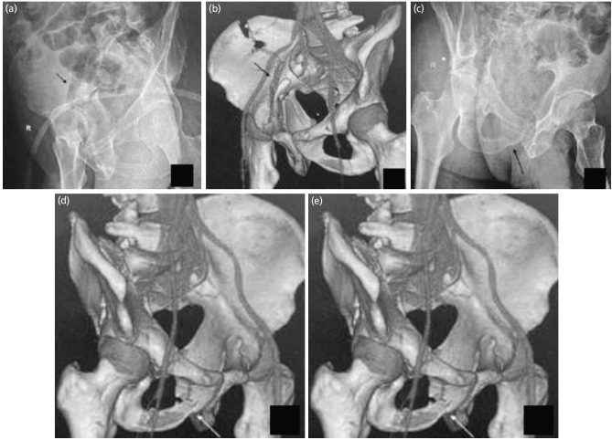 Does the Reliability and Accuracy of the Judet and Letournel Classification System for Acetabular Fractures Increase using a Novel Algorithm?