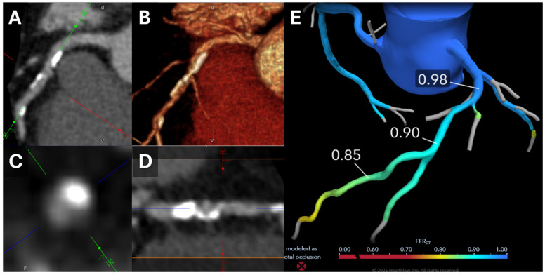 Computed Tomography and Coronary Plaque Analysis.