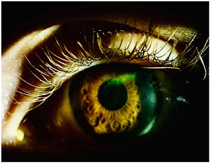 Case Series: Reactivation of Herpetic Keratitis After COVID-19 mRNA Vaccination During Herpetic Prophylaxis.