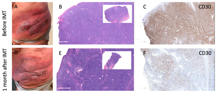 Dermatopathological Challenges in Objectively Characterizing Immunotherapy Response in Mycosis Fungoides.