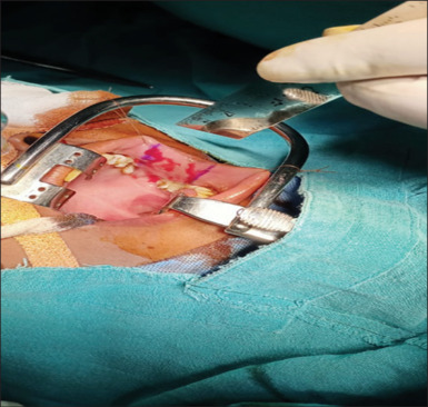 Analysis of outcome of dorsal onlay urethroplasty using buccal mucosal graft and vaginal wall graft for female urethral stricture.