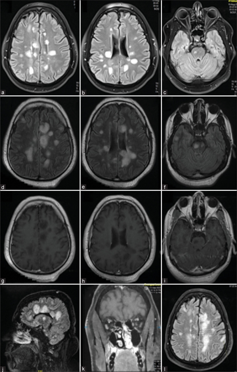 A Patient with Marburg's Variant of Multiple Sclerosis Responded Well to Cyclophosphamide.