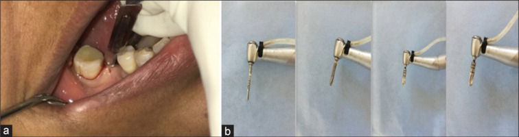 Comparison of bacterial colonization of implant abutment internal recess in internal hex and conical connection implants: An in vivo prospective study.