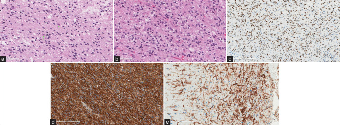 Polymorphous low-grade neuroepithelial tumor of the young.