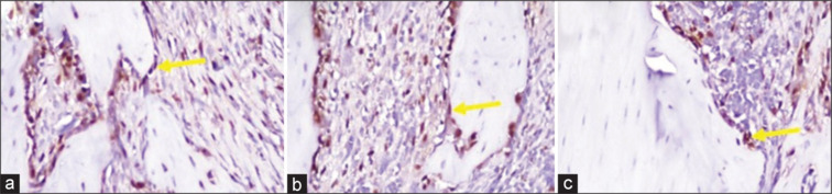 Enhanced osteogenic marker expression in alveolar bone via hydroxyapatite gypsum puger cassava starch scaffold: An in vivo study.