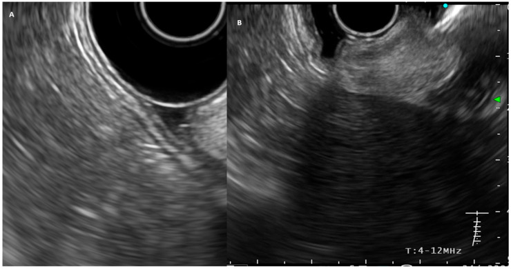 Endoscopic Ultrasound (EUS) in Gastric Cancer: Current Applications and Future Perspectives.