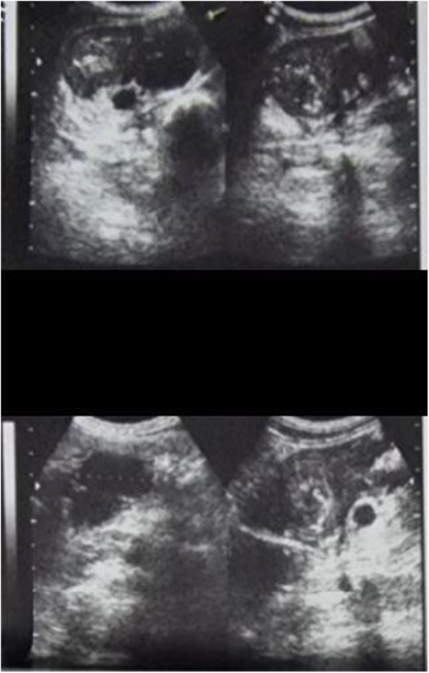 A 17-year-old female with Down syndrome and Crohn's disease: a rare case report from Syria.