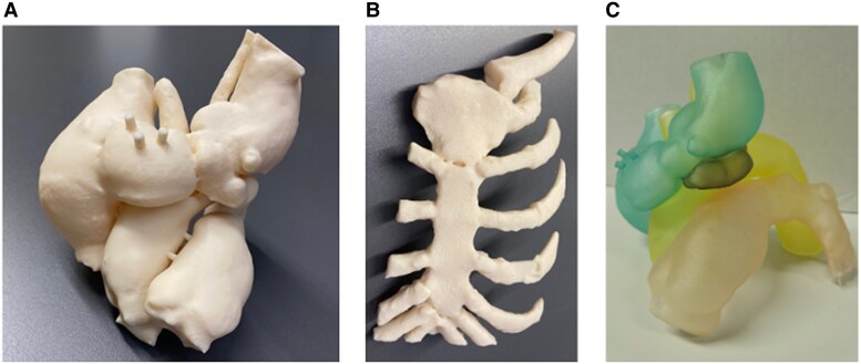Arteriovenous fistula in the aortic arch: a case report involving 3D models for surgical planning.