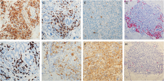 Primary Cutaneous CD4+ Small/Medium-Sized T-Cell Lymphoproliferative Disorder: A Retrospective Cohort Study of 40 Adult Patients.