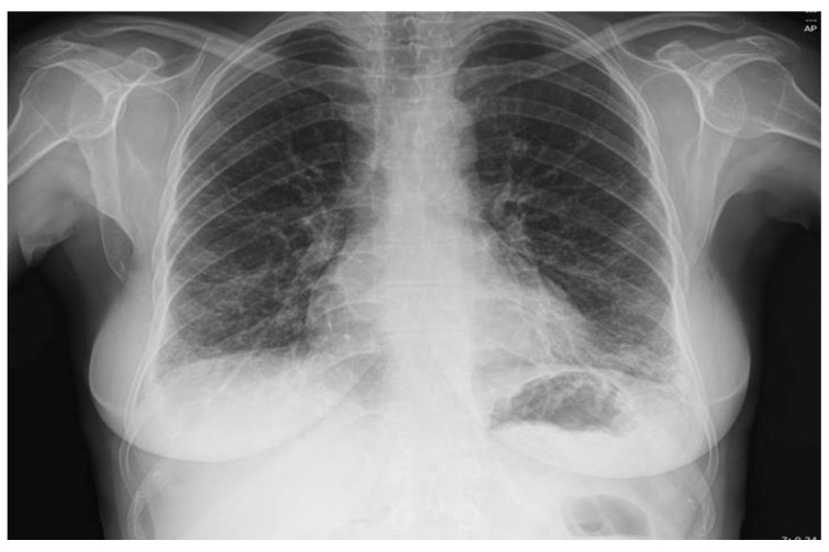 Reclassification of Seronegative Rheumatoid Arthritis as Anti-PL-12 Antisynthetase Syndrome with Interstitial Lung Disease and Joint Involvement-Case Report.