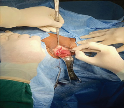 Analysis of outcome of dorsal onlay urethroplasty using buccal mucosal graft and vaginal wall graft for female urethral stricture.