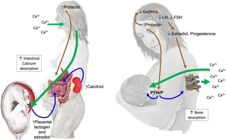 Pregnancy and Lactation Associated Bone Fragility.