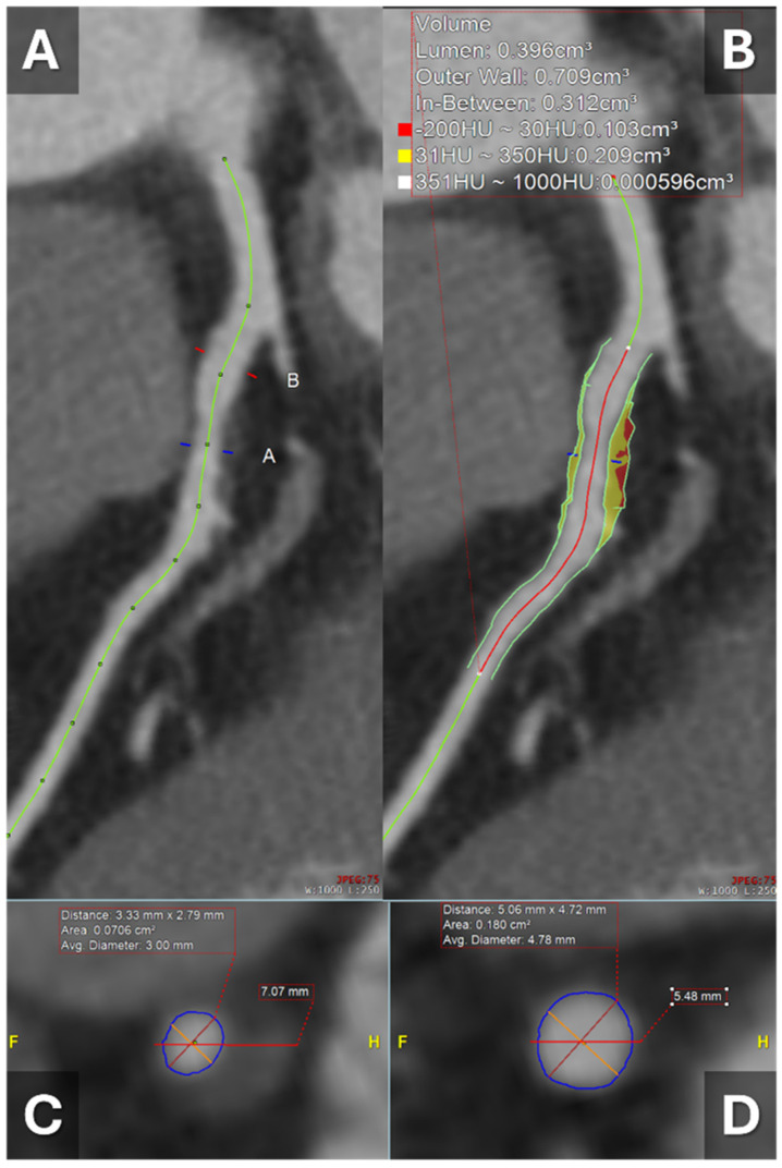 Computed Tomography and Coronary Plaque Analysis.