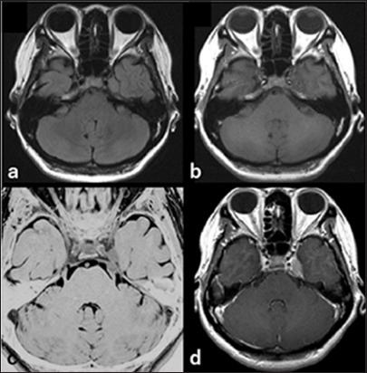 Symptomatic pseudotumor in Meckel cave mimics trigeminal schwannoma.