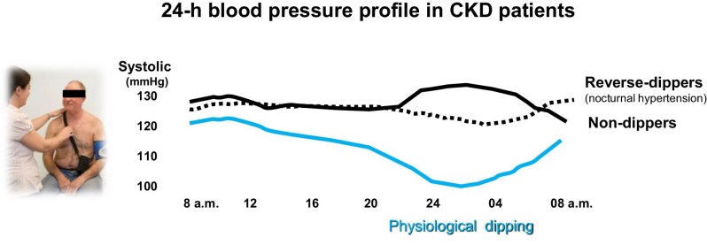 Hypertension burden in CKD: is nocturnal hypertension the primary culprit?