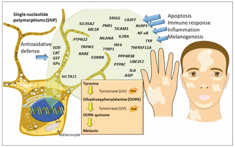 Unraveling genetic predisposition and oxidative stress in vitiligo development and the role of artificial intelligence (AI) in diagnosis and management.
