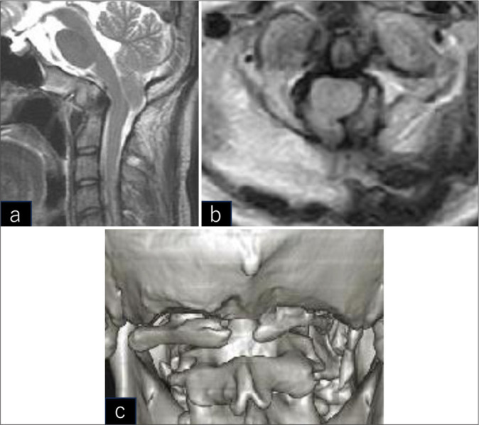 Mini-open exoscopic surgery for C1 restenosis 7 years after decompression of Chiari malformation type 1 with atlas assimilation.