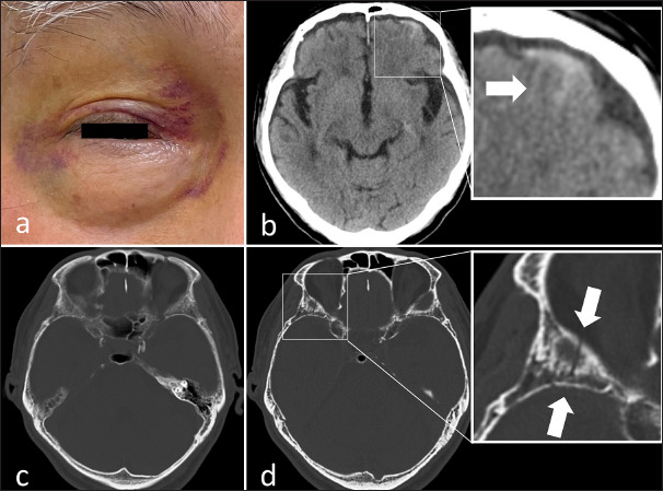 Contrecoup raccoon sign following minor posterior head injury without visible injury: Diagnostic challenge in an asymptomatic older adult man.