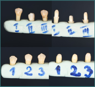 Experimental study on the compressive strength of fixed prosthetic restorations on tooth preparations with or without horizontal preparation.