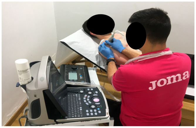 Percutaneous Electrolysis, Percutaneous Peripheral Nerve Stimulation, and Eccentric Exercise for Shoulder Pain and Functionality in Supraspinatus Tendinopathy: A Single-Blind Randomized Clinical Trial.