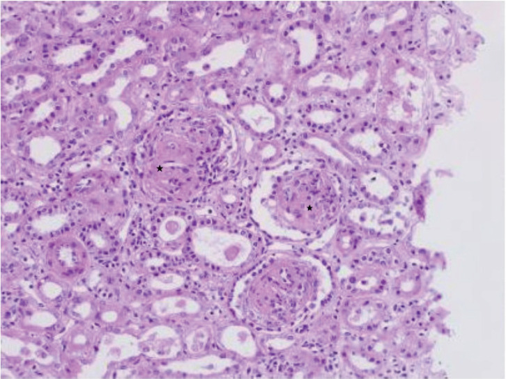 Novel <i>TRPV4</i> Gene Mutation and Diffuse Mesangial Sclerosis in Steroid Resistant Nephrotic Syndrome.