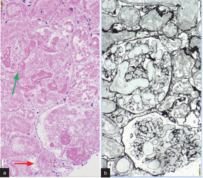 Sono-graphic Rim Sign in Postpartum Renal Cortical Necrosis: Experience at a Tertiary Care Centre.