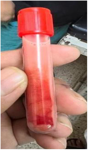 Hypertriglyceridemia induced acute pancreatitis in pregnancy: a case report.