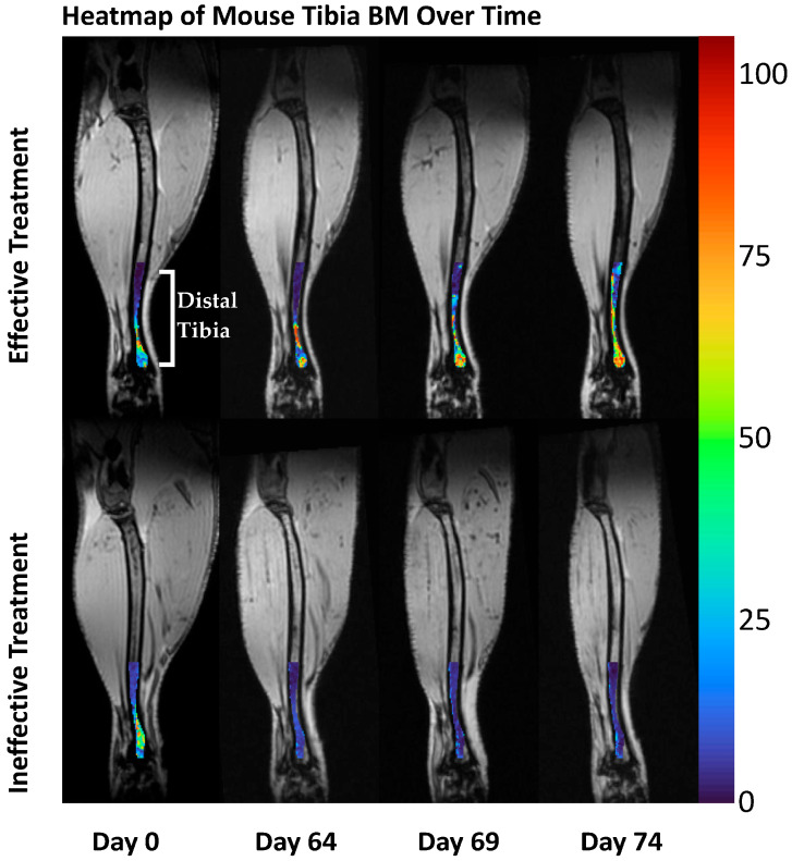 Fat Fraction MRI for Longitudinal Assessment of Bone Marrow Heterogeneity in a Mouse Model of Myelofibrosis.