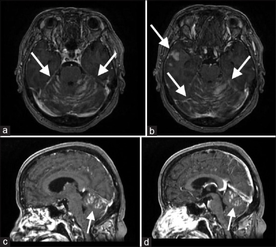 Sugar-Coating or Zuckerguss Appearance on Magnetic Resonance Imaging in Leptomeningeal Carcinomatosis in a Patient with Acute Myeloid Leukemia.