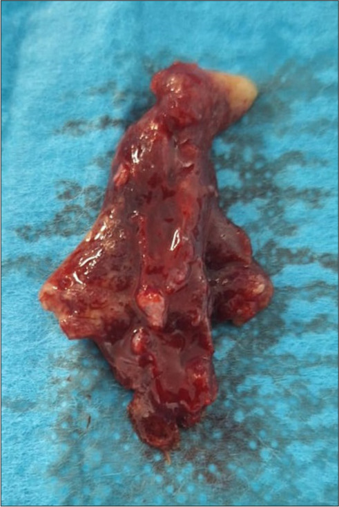 Paraplegia due to epidural T3-T5 hemorrhage of cavernous hemangioma.