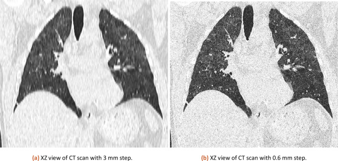 Estimation of Covid-19 lungs damage based on computer tomography images analysis.